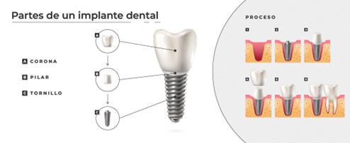 foto con contenido sobre implantes dentales