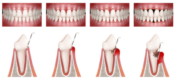 foto tratamiento periodoncia