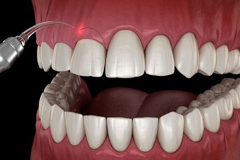 diseño animado de dientes en proceso de gingivoplastia