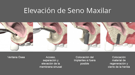 proceso cirugía elevación de seno maxilar